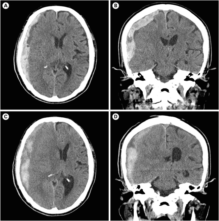 Tailored Tissue Plasminogen Factor Injection via Subdural Catheter for Subacute Subdural Hematoma in an Elderly Patient: A Case Report and Literature Review.