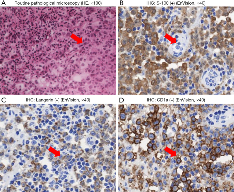 Clinical features and pathological analysis of primary rib Langerhans cell histiocytosis: case series and literature review.