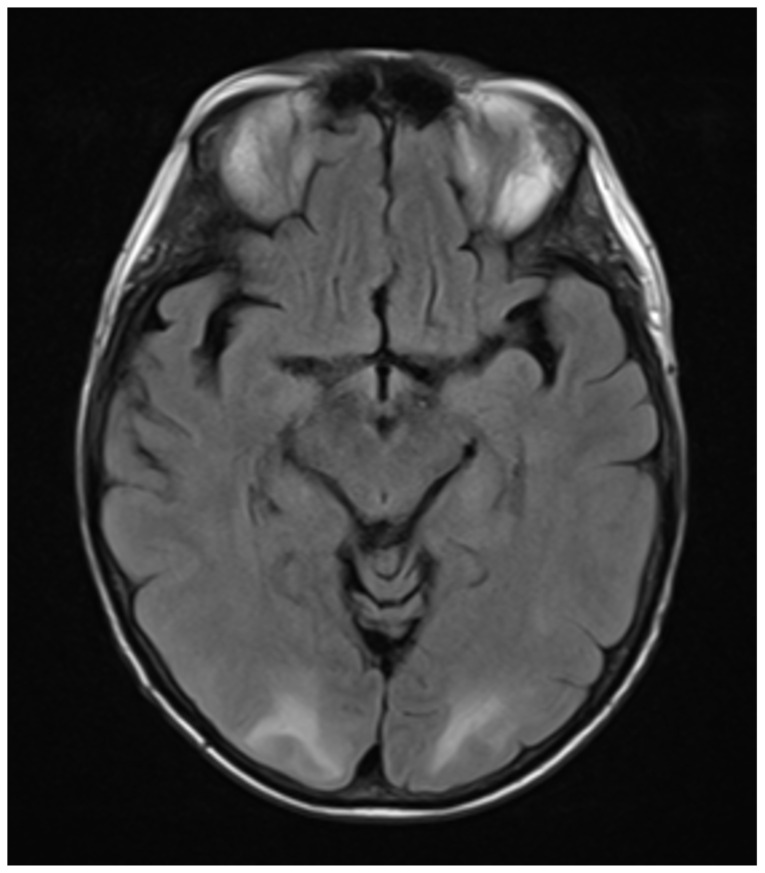 Posterior Reversible Encephalopathy Syndrome and Eclampsia.