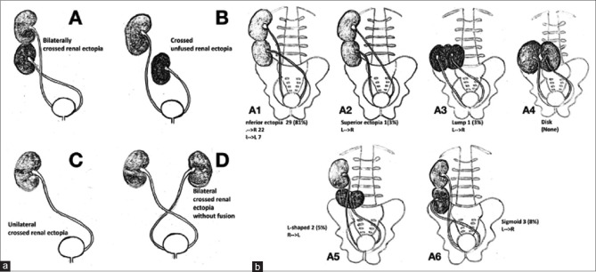 Laparoscopic nephrectomy in crossed-fused inferior ectopic kidneys - Defusing complexities: A case series.