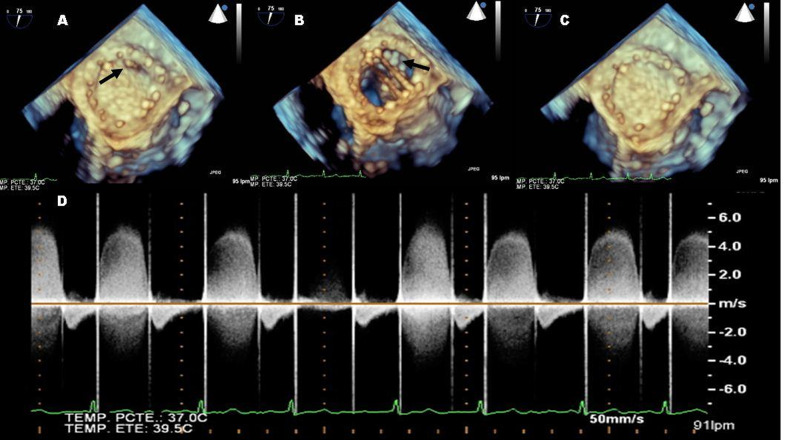 Intermittent mitral prosthetic dysfunction. what interferes the valve closure?