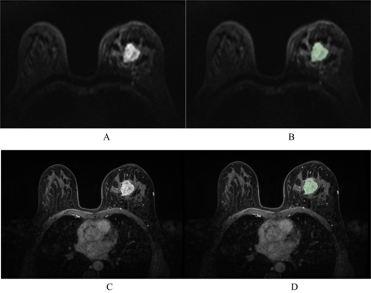 Establishment of an interpretable MRI radiomics-based machine learning model capable of predicting axillary lymph node metastasis in invasive breast cancer.