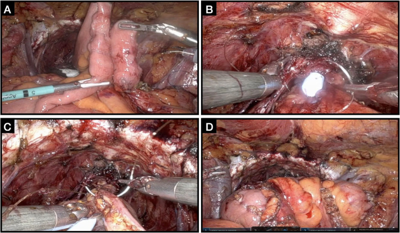 Salvage robotic-assisted radical cystectomy is safe in patients with history of pelvic irradiation.