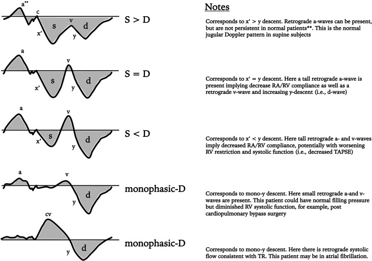 Jugular Venous Doppler Ultrasound as a Non-Invasive Window to Right Heart Hemodynamics: A Narrative Review and Future Perspective.