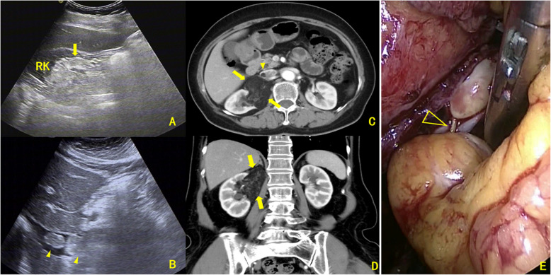 Clinical and imaging characteristics of classic angiomyolipoma with venous tumor thrombosis: a comparative analysis against renal cell carcinoma.