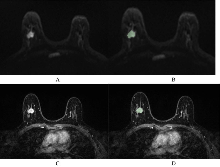 Establishment of an interpretable MRI radiomics-based machine learning model capable of predicting axillary lymph node metastasis in invasive breast cancer.
