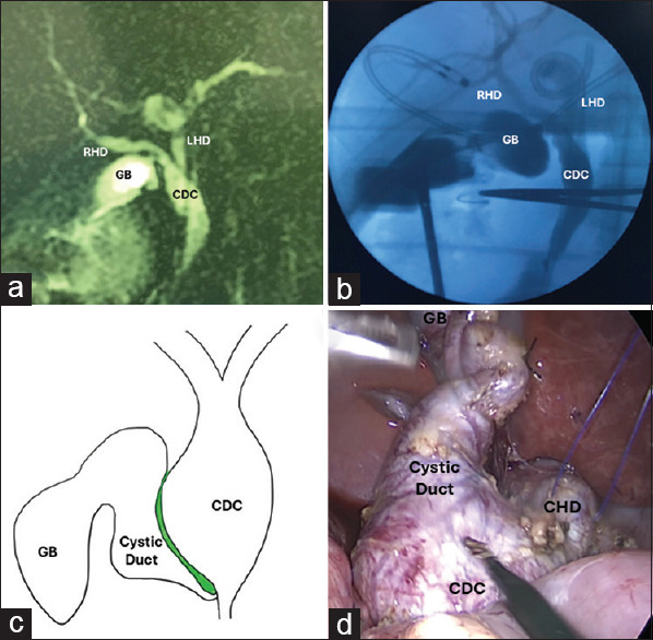 Laparoscopic management of variant ductal and vascular anatomy in children with choledochal cysts.