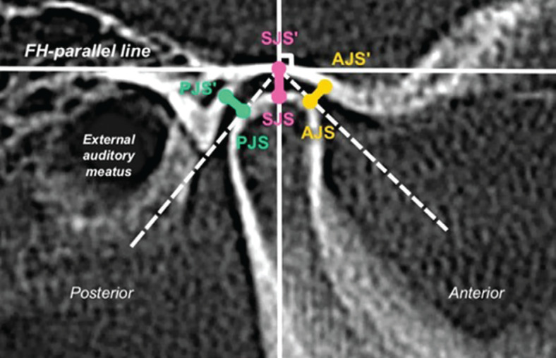 Impact of Camouflage Treatment with Class III Elastics on Temporomandibular Joint and Dentoskeletal Relationships: A Pilot CBCT and MRI-Based Clinical Trial.
