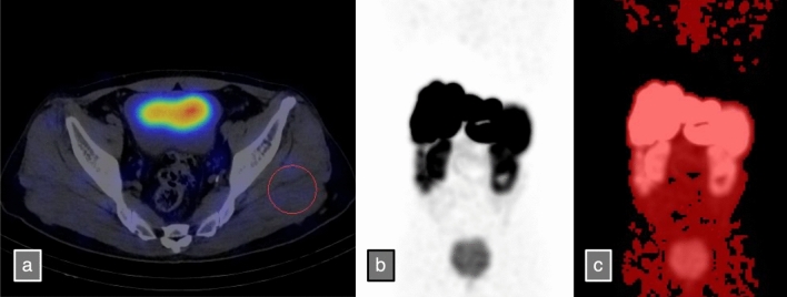 Factors and predictors affecting late external dose rates and isolation period in patients after lutetium-177-labeled DOTA-Tyr3-octreotate treatment for neuroendocrine tumors
