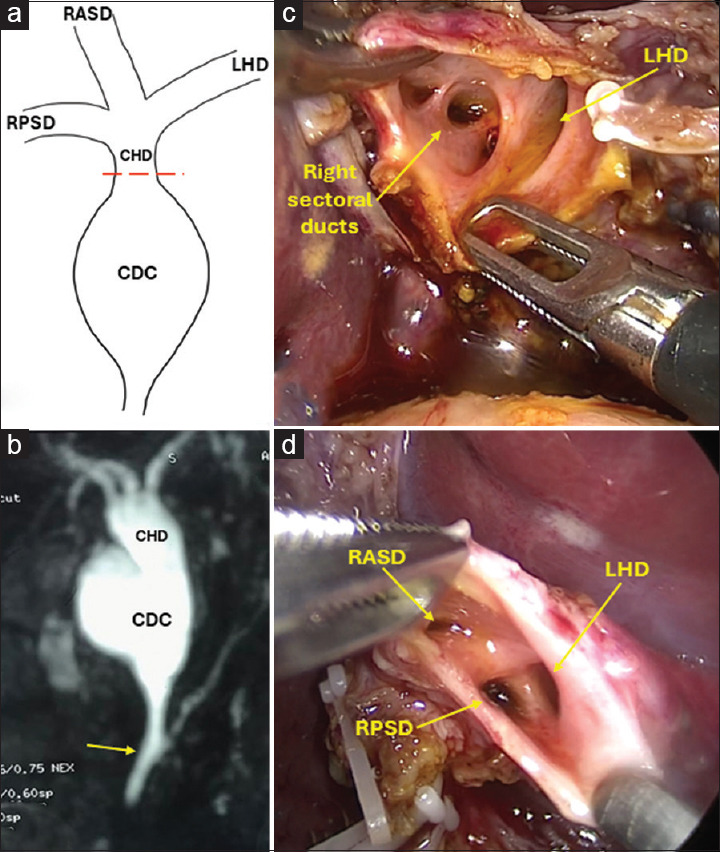 Laparoscopic management of variant ductal and vascular anatomy in children with choledochal cysts.