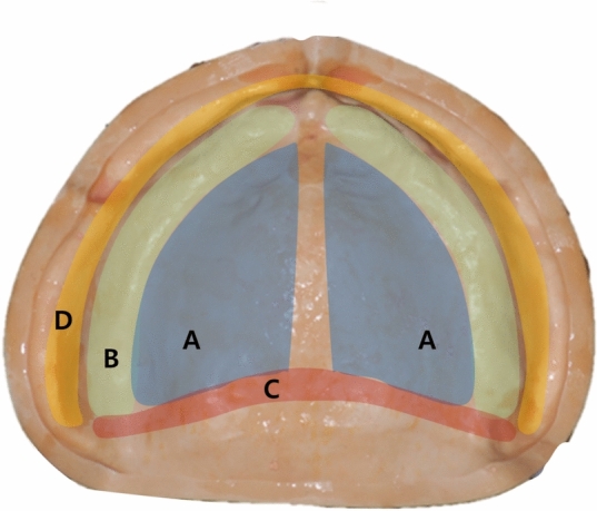 Three dimensional analysis on the deformation of the master cast during maxillary complete denture fabrication.