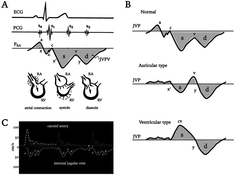 Jugular Venous Doppler Ultrasound as a Non-Invasive Window to Right Heart Hemodynamics: A Narrative Review and Future Perspective.