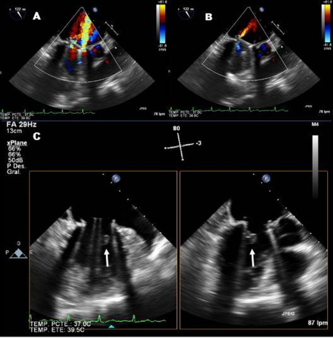 Intermittent mitral prosthetic dysfunction. what interferes the valve closure?