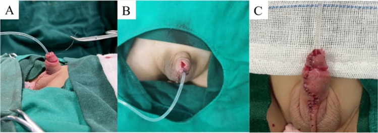 Application of glanular decompression and expansion surgery in proximal hypospadias with hypoplastic glans penis.