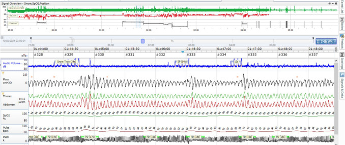 Obstructive Sleep Apnea Syndrome in women: gender in sleep respiratory medicine is a first step towards personalized medicine.