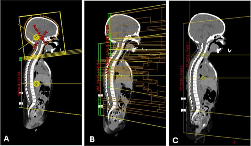 Relative risk of cardiac mortality and dosimetric comparison among three-dimensional radiotherapy, volume-modulated arc therapy and proton beam in vertebral-body reduced-dose craniospinal irradiation.