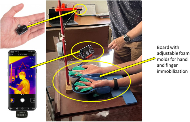 Pre-clinical evaluation of a low-cost tool for skin temperature measurements as a proxy to assess autonomic nerve function in leprosy neuropathy.
