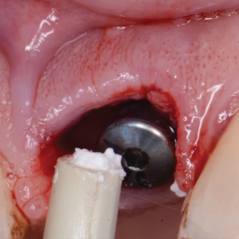 A Retrospective Study Using a Novel Body-Shift Implant Design with a Novel Alloplastic Particulate Grafting Material in Immediate Extraction Sockets.