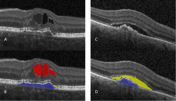 Automated fluid monitoring to optimize the follow-up of neovascular age-related macular degeneration patients in the Brazilian population.