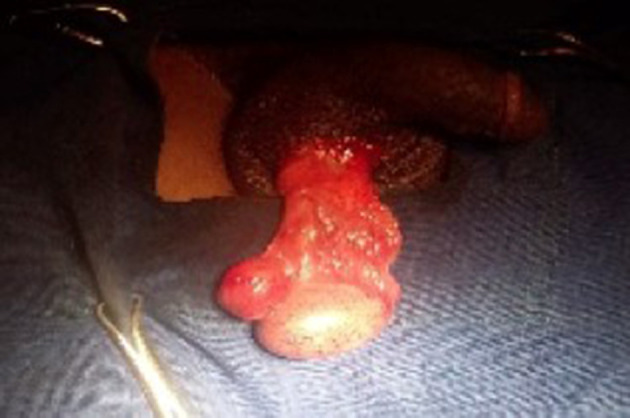 Atypical Testicular Torsion Due to an Epididymal Cyst in a Young Adult: Case Report.
