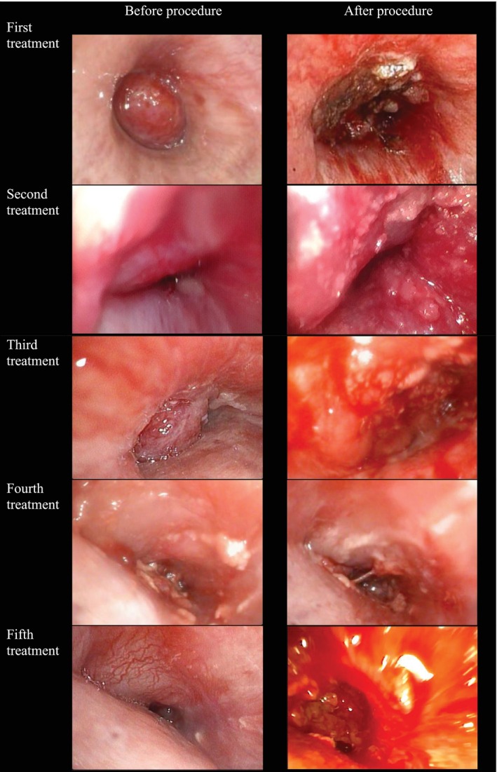 Central Airway Recanalisation Using Dual Debulking With Para-Toluenesulfonamide (CLEAR-DUAL-PTS).
