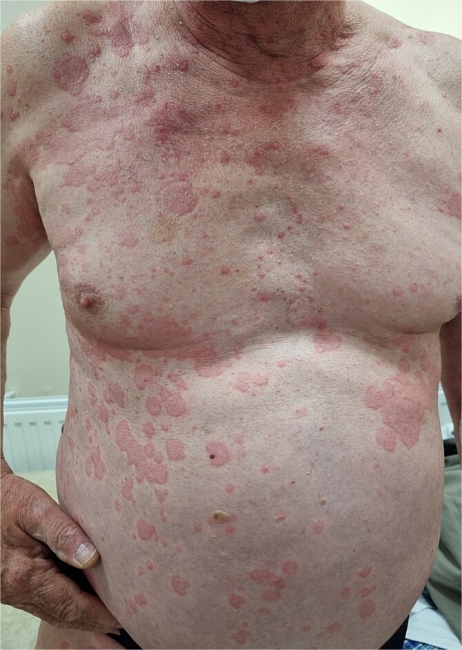 Schnitzler syndrome - a rare cause of chronic urticaria. Case report.