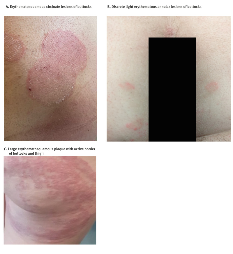 Autochthonous transmission of <i>Trichophyton indotineae</i> through sexual contact, France, 2024.
