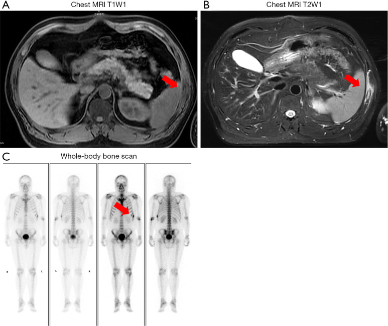 Clinical features and pathological analysis of primary rib Langerhans cell histiocytosis: case series and literature review.