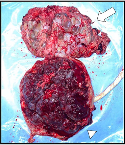 Hydatidiform Mole and coexisting fetus following intrauterine insemination: a case report.