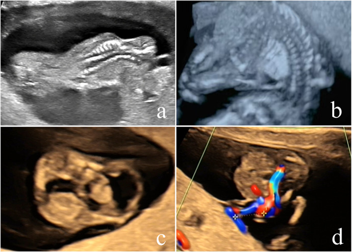 Characteristic Analysis of Ultrasound Diagnosis of Limb Body Wall Complex in Early Pregnancy.