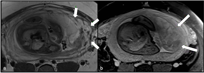 Hydatidiform Mole and coexisting fetus following intrauterine insemination: a case report.