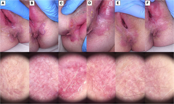 High-Intensity Focused Ultrasound (HIFU) Treatment of Vulvar Lichen Sclerosus.