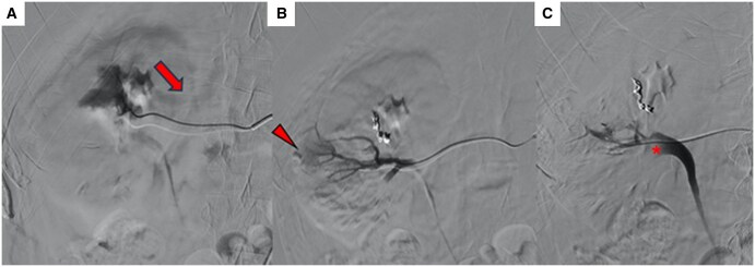 An unusual renal colic during trans-arterial embolization after trauma and its multidisciplinary management.