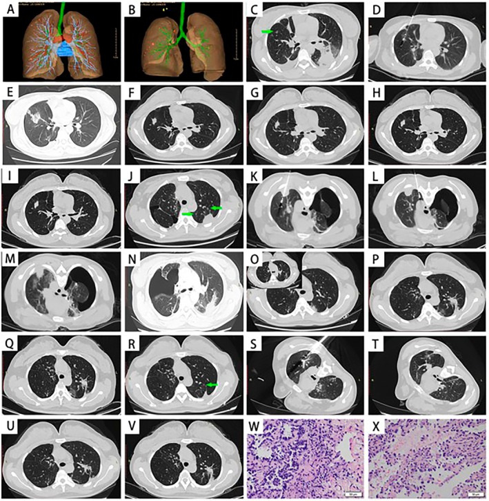 Surgical Outcomes of Video-Assisted Thoracic Surgery Combined With Computed Tomography-Guided Microwave Ablation for Lung Cancer Presenting as Multiple Ground-Glass Opacities: A 5-Year Retrospective Cohort Study.