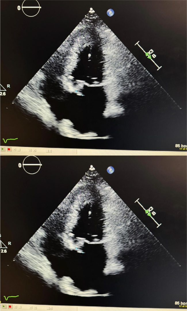 A Rare Confluence: Hepatic Artery Aneurysm and Infective Endocarditis in a Patient with a Mitral Valve Prosthesis.