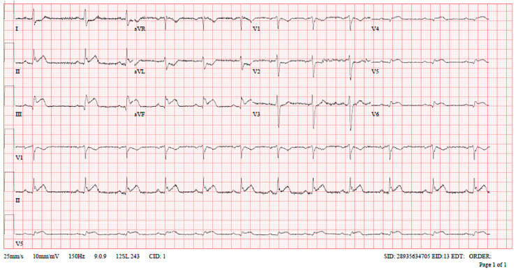 Clomiphene-induced myocardial infarction in a young male: A case report of a rare cardiovascular complication.