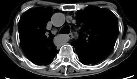 Methotrexate-associated Hodgkin Lymphoma Occurring Decades after Methotrexate Initiation.