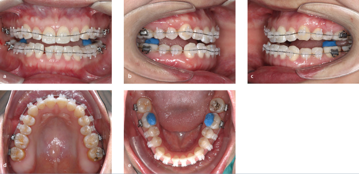 Impact of Camouflage Treatment with Class III Elastics on Temporomandibular Joint and Dentoskeletal Relationships: A Pilot CBCT and MRI-Based Clinical Trial.