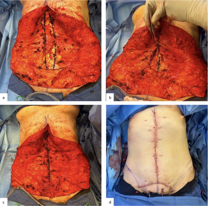 Mesh suture repair of rectus diastasis with and without a concurrent ventral hernia.