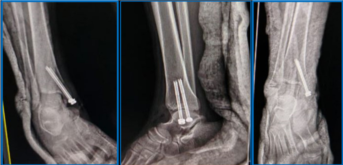 Percutaneous versus open cannulated screws fixation for displaced isolated medial malleolar fractures in adults: a randomized controlled clinical trial.