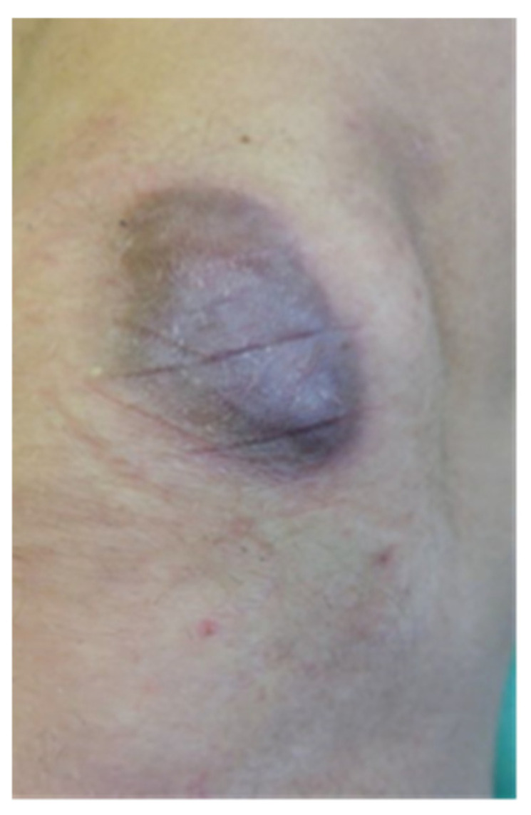 Assessment of the Effect of Kinesiology Taping on Scar Treatment in Children.