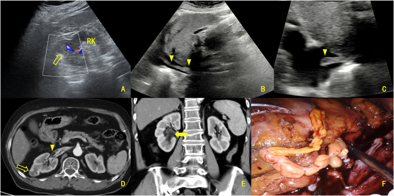 Clinical and imaging characteristics of classic angiomyolipoma with venous tumor thrombosis: a comparative analysis against renal cell carcinoma.