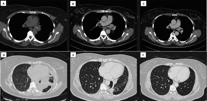 Central Airway Recanalisation Using Dual Debulking With Para-Toluenesulfonamide (CLEAR-DUAL-PTS).