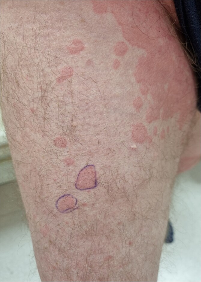 Schnitzler syndrome - a rare cause of chronic urticaria. Case report.