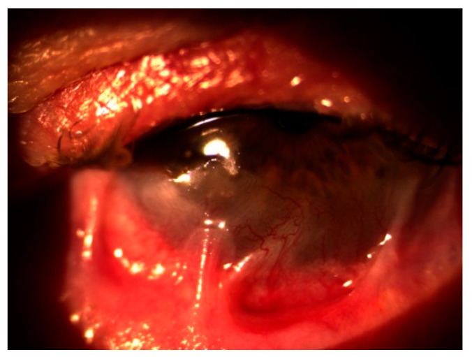 Rituximab Therapy in Refractory Ocular Cicatricial Pemphigoid: A Case Report.