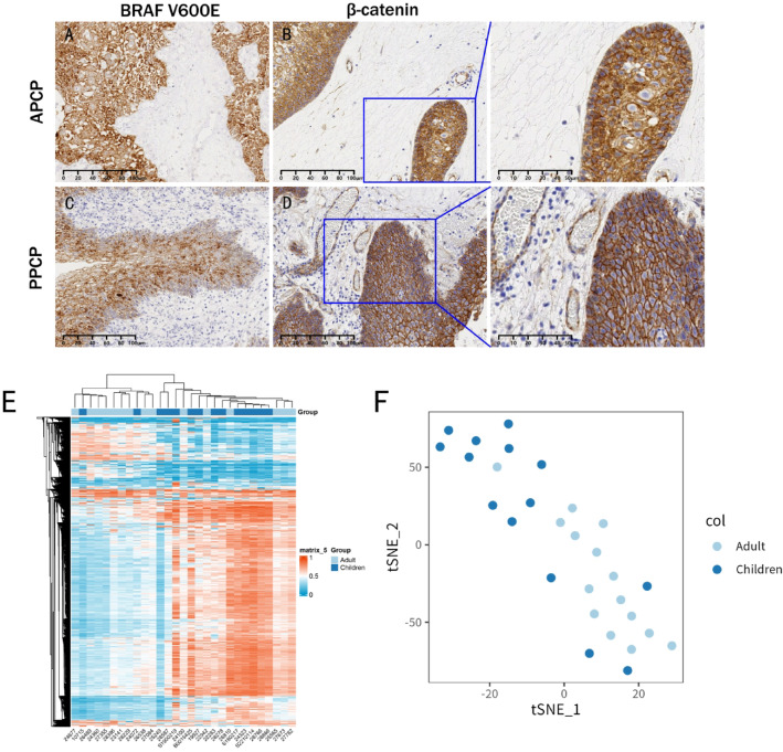 Comparative analysis of clinical features, methylation and immune microenvironment in pediatric and adult papillary craniopharyngiomas: results from a multicenter study.
