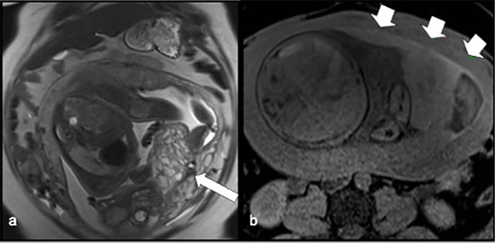 Hydatidiform Mole and coexisting fetus following intrauterine insemination: a case report.