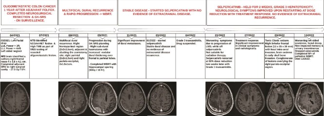 RET-fusion metastatic colon cancer responding to selpercatinib-a case report.