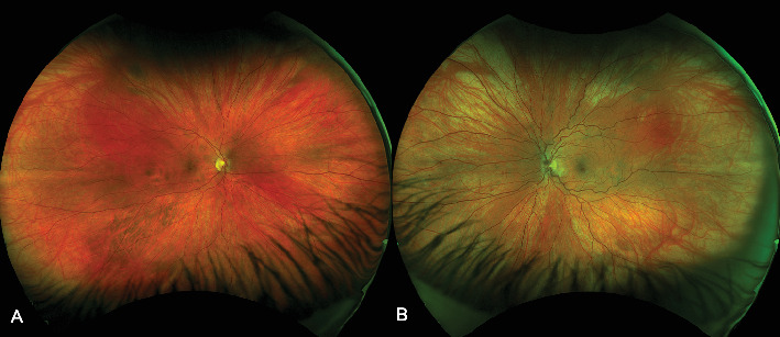 Central Retinal Vein Occlusion Associated With Progestin-Only Contraceptive Implant Use.