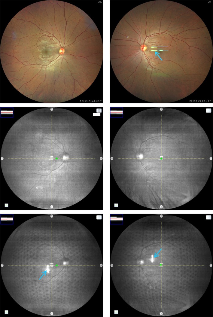 Retinal shadows of multisegment lenses in fundus imaging.